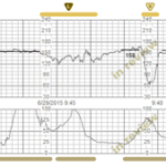 A PeriCALM Patterns tracing chronicles the progression of a mixed pattern of decelerations